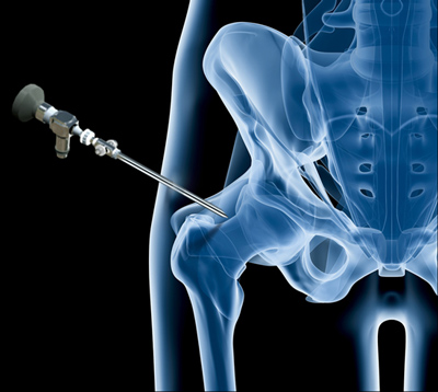 Arthroscopic Surgery